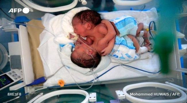  نجاح عملية فصل توأم سيامي يمني ملتصق من جهة البطن
